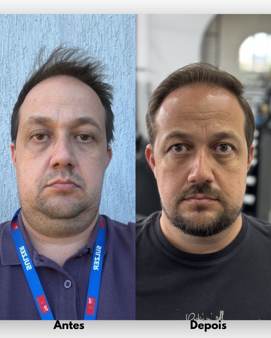 Antes e depois frontal de cliente com barba e cabelo alinhados